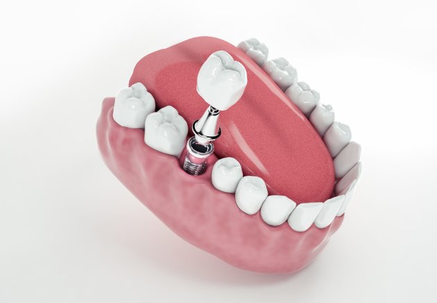 Implantes dentales en CDMX: la solución ideal para tu sonrisa
