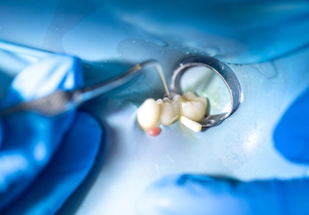 Incrustaciones en CDMX: La solución ideal para restaurar tus dientes